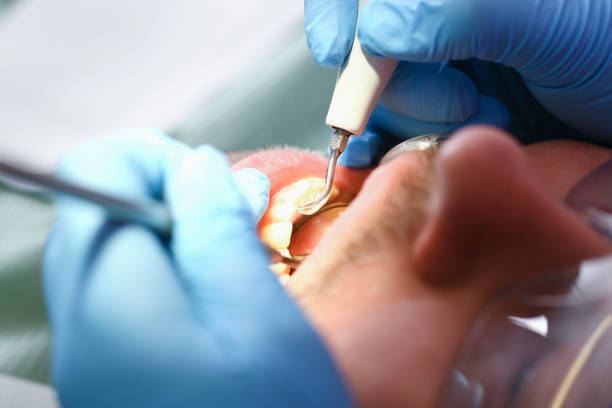 Best Dental Abscess Treatment in North Merritt Island, FL